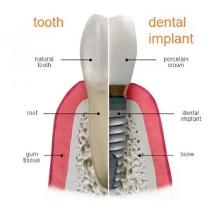 Dental Implant Crowns